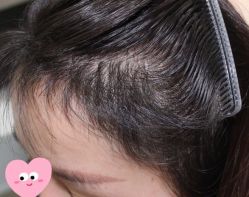 -大麦微针植发丨全国连锁