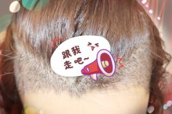 -大麦微针植发全国连锁