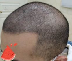 -大麦微针植发丨全国连锁