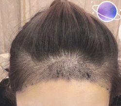 -大麦微针植发丨全国连锁