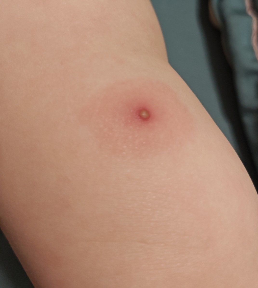 天天领红包小孩子腿上长了个水泡,是什么