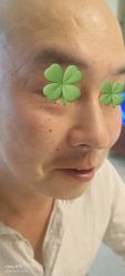 -美丽人生祛斑扁平疣汗管瘤中心