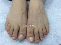 点击看大图 -德哥灰指甲脚气甲沟炎跖疣护理