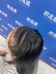 -碧莲盛不剃发植发