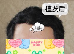 -大麦微针植发全国连锁