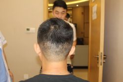 -大麦微针植发丨全国连锁