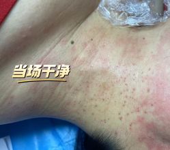 -爱莎扁平疣·汗管瘤·斑痣中心