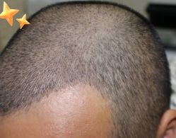 -大麦微针植发丨全国连锁