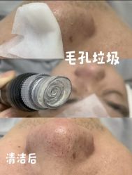 -木棉问题肌·肩颈·纹绣