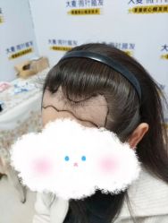 -大麦微针植发丨全国连锁