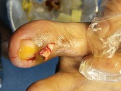-祖传修脚甲沟炎灰指甲鸡眼