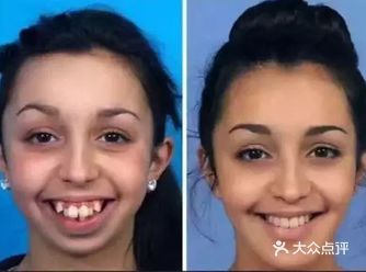 下列人群不适宜做牙齿整形: (1)患有急性传染病的人