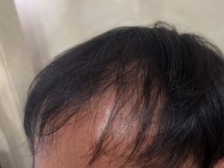 -碧莲盛·不剃发植发