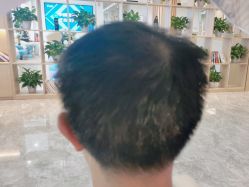 -碧莲盛·不剃发植发