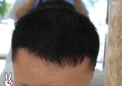 -大麦微针植发丨全国连锁