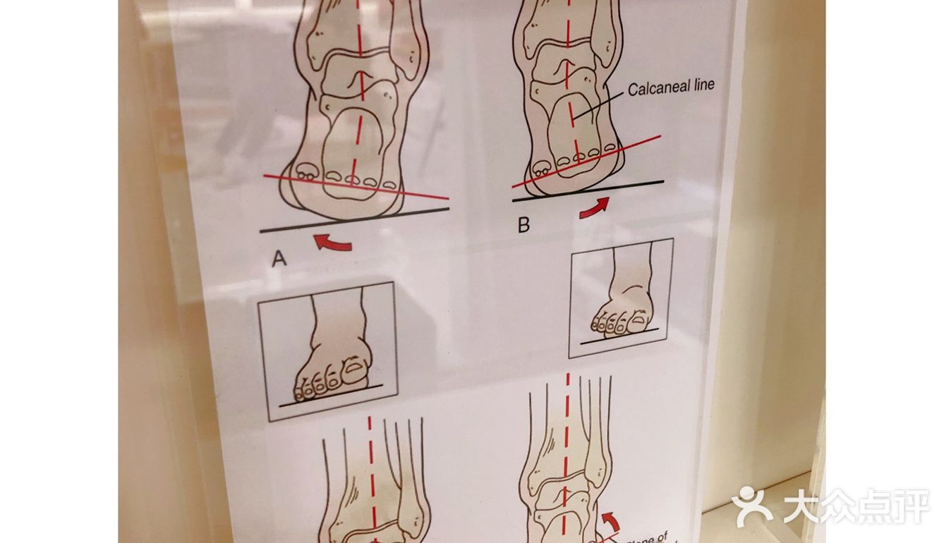 足部矫正找哪家？SENSOPED橙捷足部矫形中心