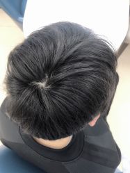 点击看大图 -大麦微针植发丨全国连锁