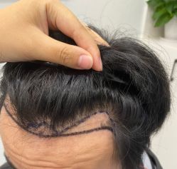 -大麦微针植发全国连锁
