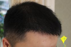 -大麦微针植发丨全国连锁