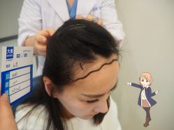 -大麦微针植发丨全国连锁