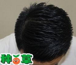 -大麦微针植发丨全国连锁