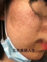-美丽人生祛斑扁平疣汗管瘤中心