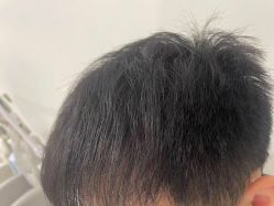 -碧莲盛·不剃发植发