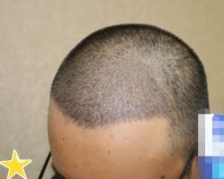 -大麦微针植发丨全国连锁