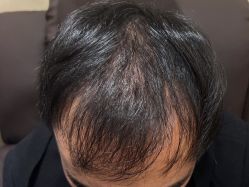 -碧莲盛·不剃发植发