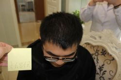 -大麦微针植发丨全国连锁