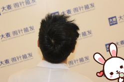 -大麦微针植发丨全国连锁