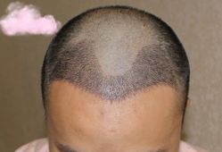 -大麦微针植发丨全国连锁