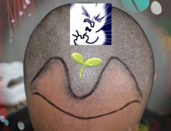 -大麦微针植发全国连锁