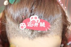 -大麦微针植发全国连锁