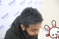 -大麦微针植发丨全国连锁