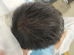 -碧莲盛·不剃发植发