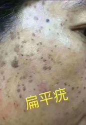 -美人痣全国连锁