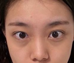 体验前-天津健丽·去眼袋医疗美容机构