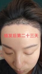 体验后-大麦微针植发丨全国连锁