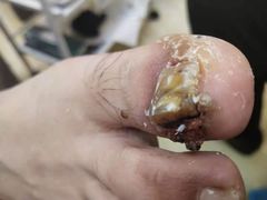 -祖传修脚甲沟炎灰指甲鸡眼
