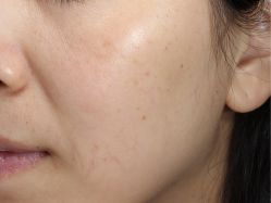 -丽美妍医疗美容·皮秒·立体分层抗衰