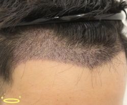 -大麦微针植发丨全国连锁