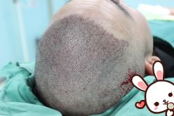 点击看大图 -大麦微针植发丨全国连锁