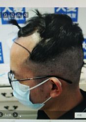 -大麦微针植发丨全国连锁