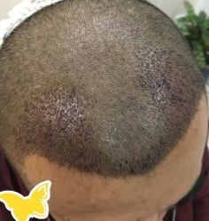 -大麦微针植发丨全国连锁