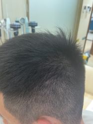 -碧莲盛·不剃发植发