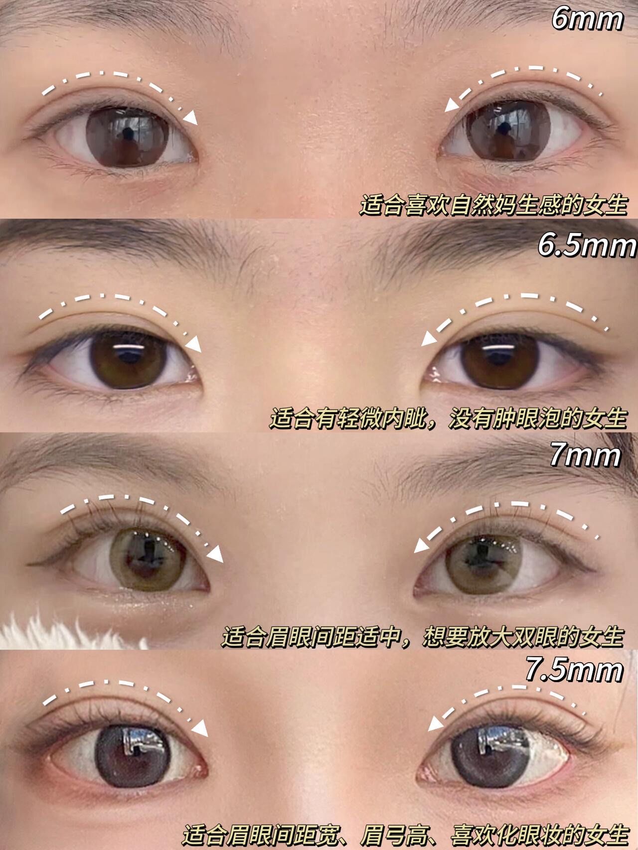 割双眼皮 #双眼皮恢复 #单眼皮变双眼皮 #埋线双眼皮 #双眼皮前后