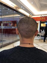 -大麦微针植发丨全国连锁