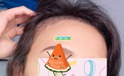 -大麦微针植发全国连锁