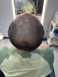 体验后-大麦微针植发全国连锁